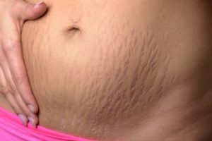 妊娠線とはなにか?消すにはどうしたらいいの?