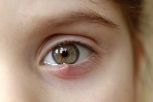 子どもの為のものもらい:治し方