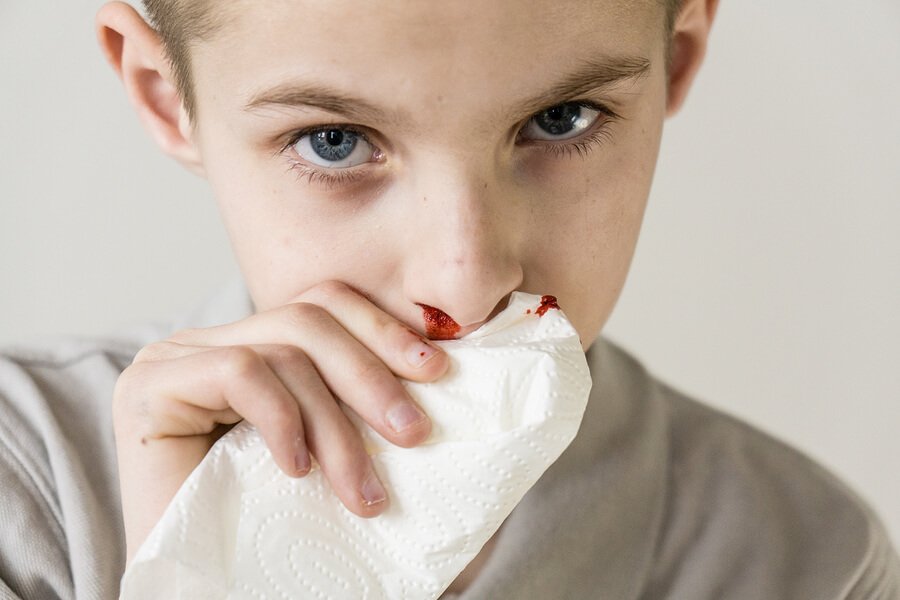 子どもの鼻血：原因と治療
