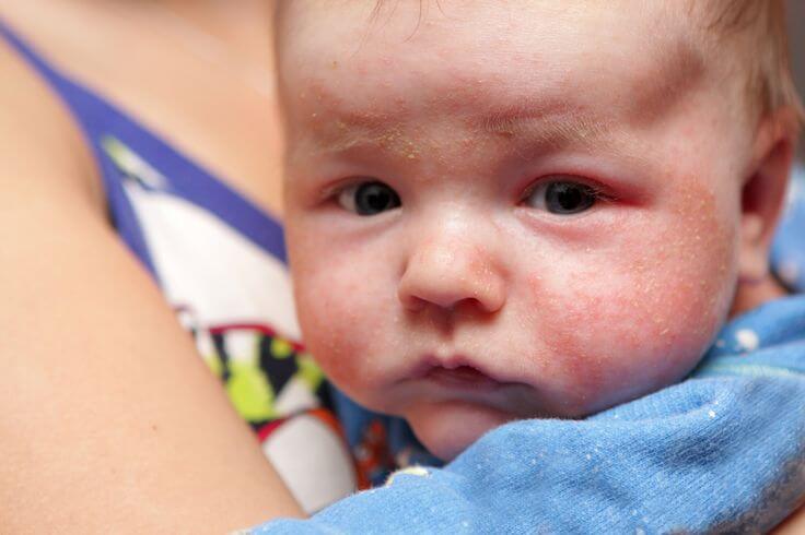 発疹が出る赤ちゃんの対処法