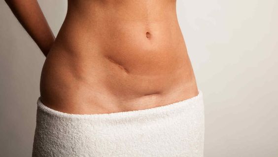 帝王切開が女性の身体に及ぼす進化的影響