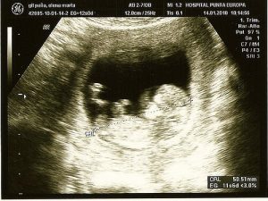 妊娠合併症を検出する革新的な技術