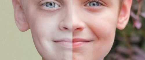 子供の白血病