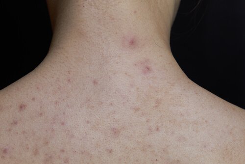 しょうこう熱について