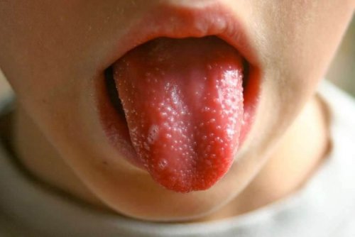 子どものしょうこう熱
