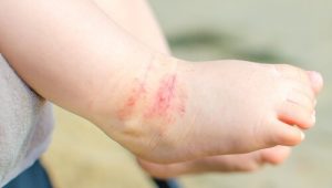 子供のアトピー性皮膚炎に関して覚えておいて欲しい15のこと