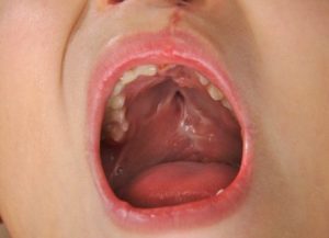 子どもの口蓋裂:知っておくべきこと