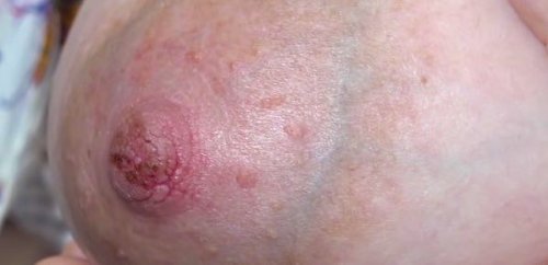 乳首のひび割れ 乳首の痛み