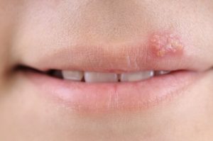 子供ヘルペス:症状、原因、そして治療