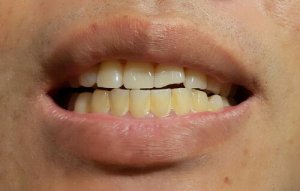子どもに健康的な白い歯を!歯の汚れについて