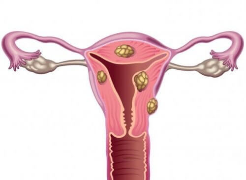 子宮筋腫と不妊症について