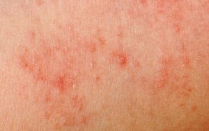 小児慢性じんましんが起きたときの対処法とは?