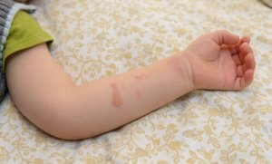 子どもが熱湯で火傷をした時の対処法