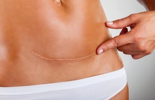 帝王切開 の傷跡ケア