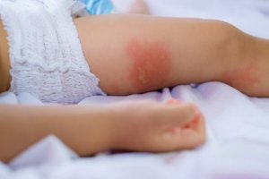 おむつかぶれの予防と治療法:赤ちゃんのデリケートな肌
