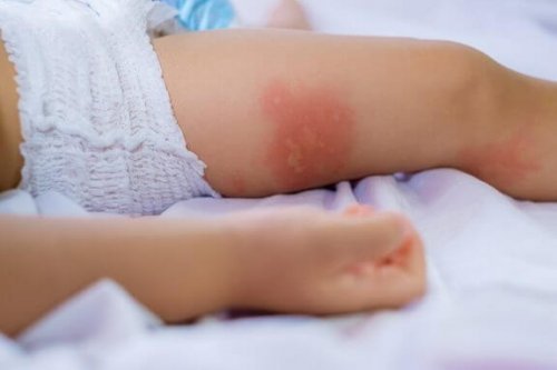 おむつかぶれの予防と治療法：赤ちゃんのデリケートな肌