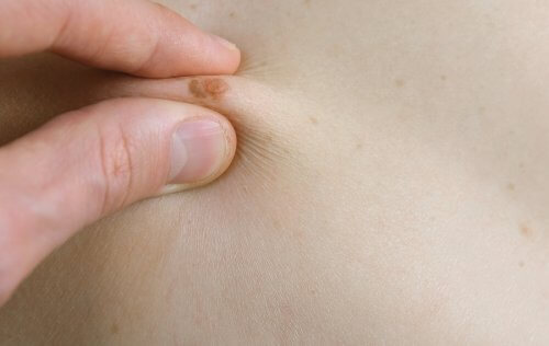 子どもの ほくろ について