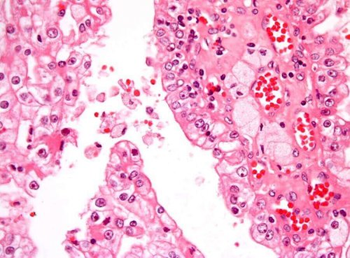 腎臓がん細胞 腎臓がん 小児期の腎臓がん 子ども