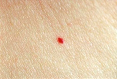 ほくろ