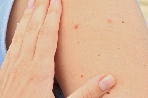子どもの ほくろ についての情報