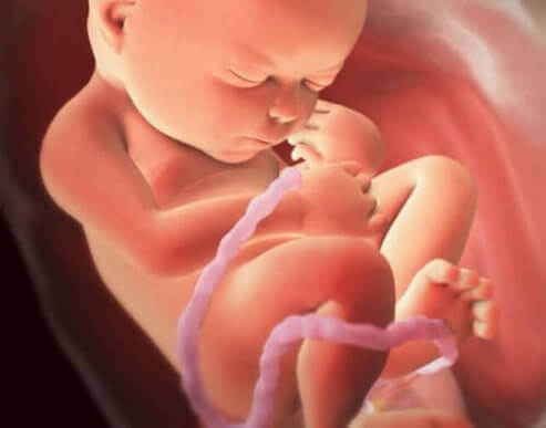 妊娠中・出産時の臍帯巻絡について