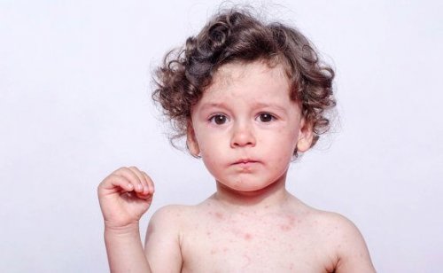 子供の汗アレルギーについて：その症状と治療法を見てみよう
