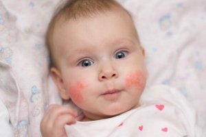 子どもの湿疹の発生を防ぐ方法:兆候を見極めて素早く対処!