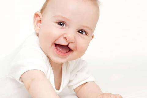 口唇裂 頭蓋顔面形態異常 赤ちゃん