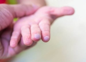 子どもが水ぶくれになっちゃった!一番良い治療法を教えて!