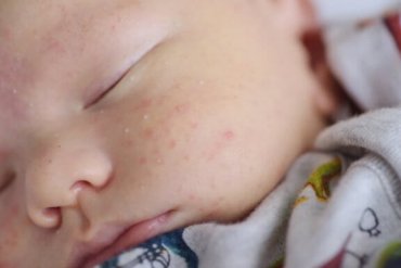 新生児の稗粒腫 はいりゅうしゅ 原因 症状 そして治療法 わたしママ