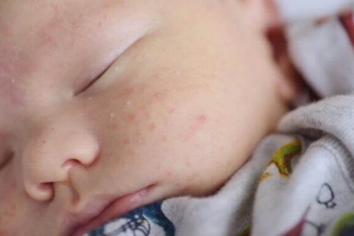 新生児の稗粒腫（はいりゅうしゅ）：原因、症状、そして治療法