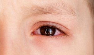 あなたは知っていますか?子どもの結膜下出血の原因
