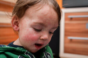 子どものアレルギー　牛乳アレルギー　